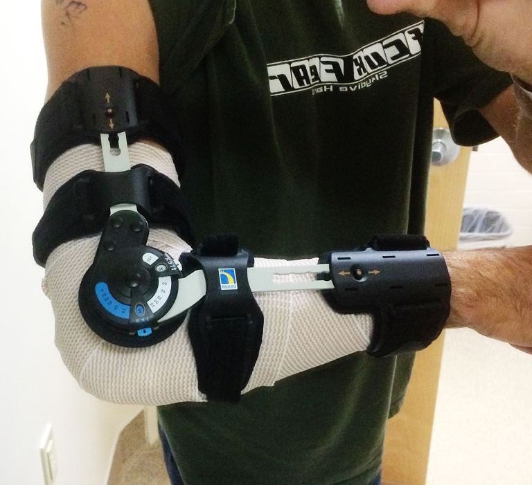 Bionic Arm paintedposies.com
